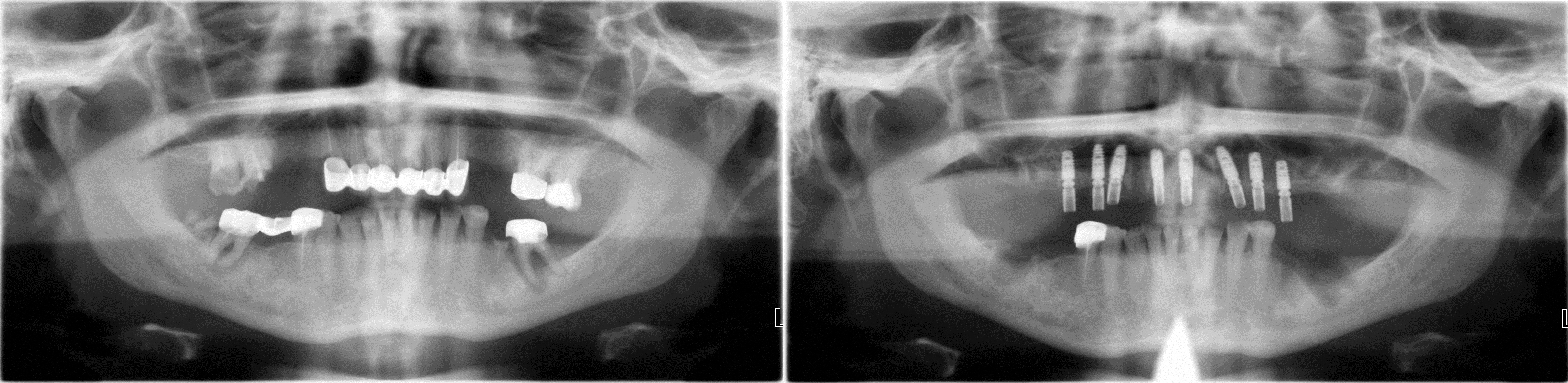 Рентгеновский снимок всей зубочелюстной системы до удаления зубов и после установки коротких и тонких имплантов в верхнюю челюсть