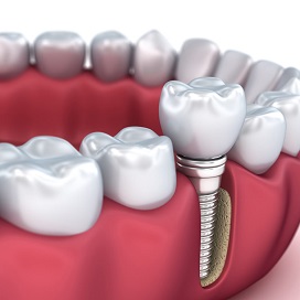 Имплантация 1 зуба по классическому протоколу