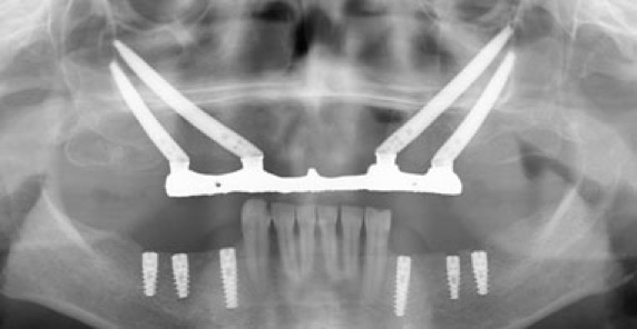 Рентгеновский снимок после установки 4 скуловых имплантов