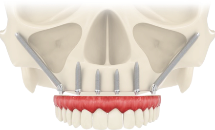 Скуловая имплантация зубов