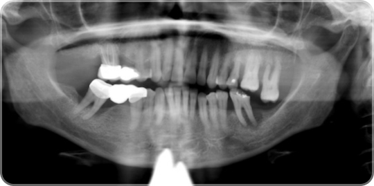 Удаление жевательных зубов