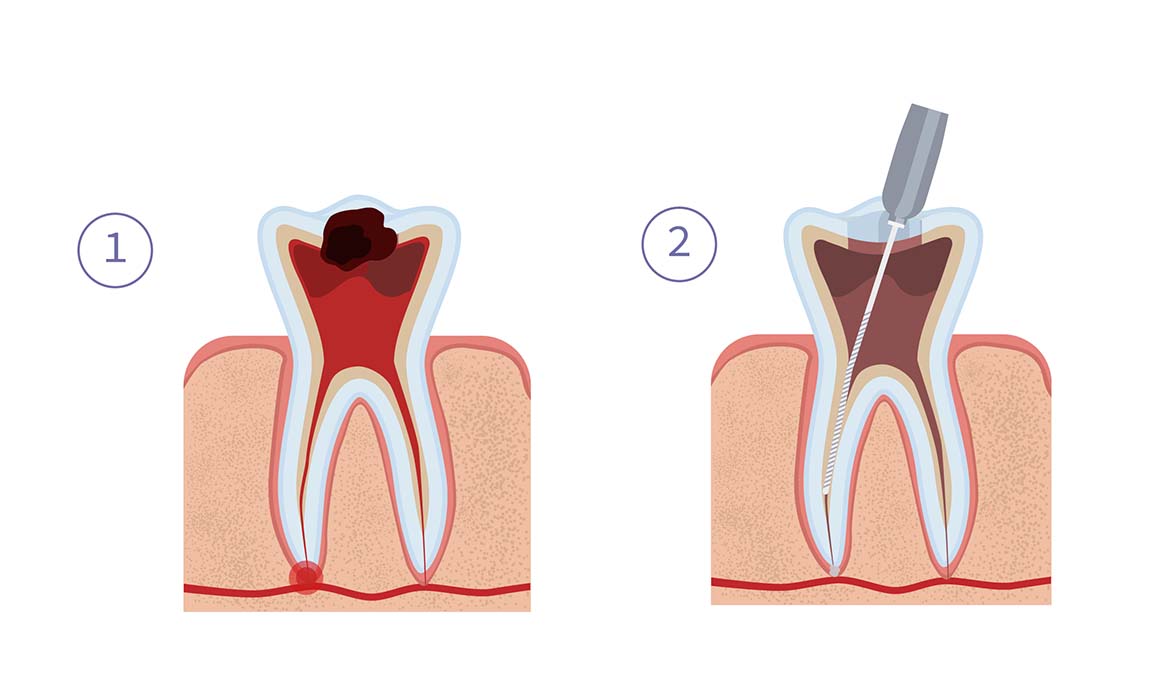 Удаление воспаленной пульпы зуба и пломбирование корневых каналов (этапы 1 и 2)