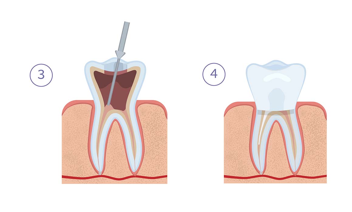 Удаление воспаленной пульпы зуба и пломбирование корневых каналов (этапы 3 и 4)