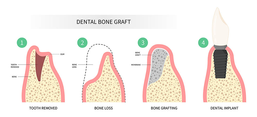Процесс разрушения и восстановления челюстной кости