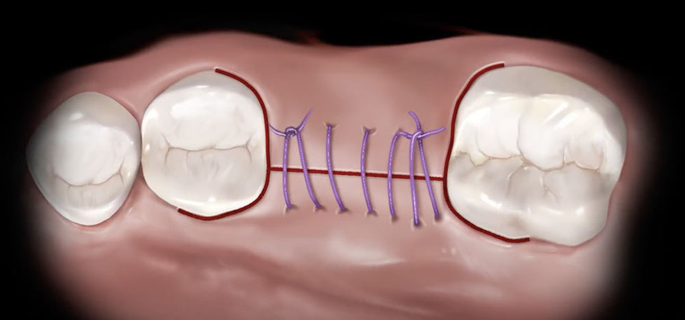 Швы после имплантации зуба