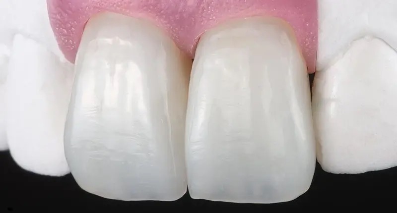 коронки из керамики E-max на передние зубы