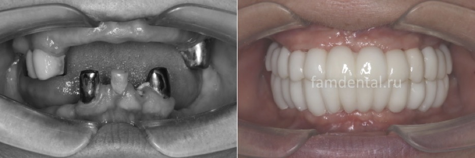 Имплантация классическим способом обеих челюстей