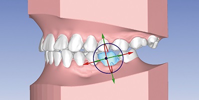 3д моделирование зубов