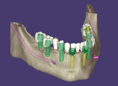 Планирование имплантации нижней челюсти