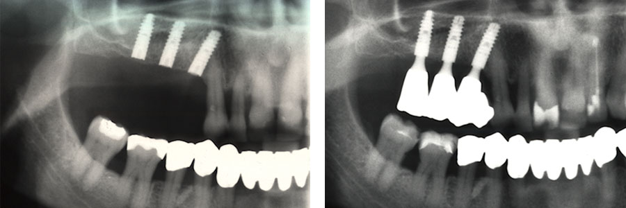 Рентгеновские снимки установленных имплантов Ankylos: слева - в 1992 году и справа - эти же импланты 20 лет спустя