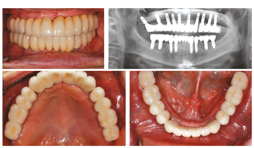 Рентгенограмма после после восстановления всех зубов у пациента