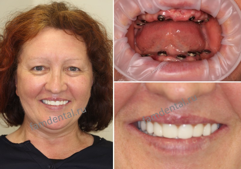 Проведена имплантация зубов обеих челюстей классическим способом с одномоментной нагрузкой несъёмным протезом.