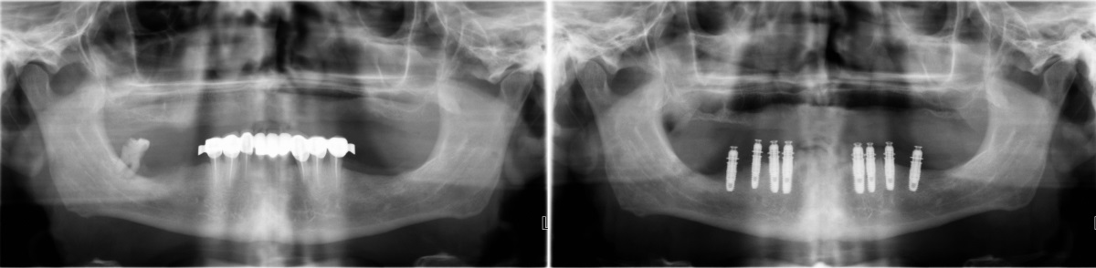 Панорамный рентгеновский снимок до и после удаления всех зубов с нижней челюсти и одномоментной установки 8 имплантов