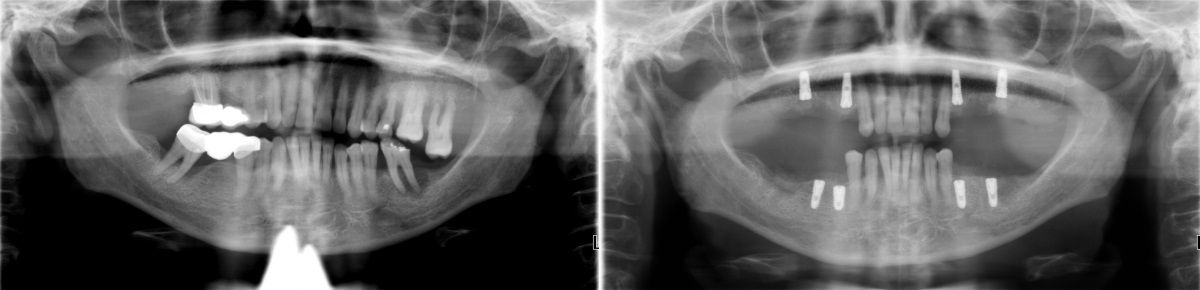 Два панорамных рентген-снимка верхней и нижней челюстей: слева - до удаления зубов и проведения синус-лифтинга, справа - после проведения этих процедур и имплантации