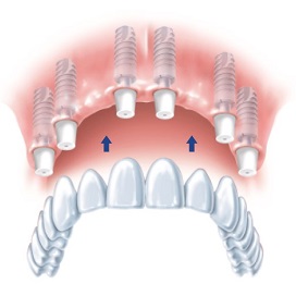 Имплантация верхней челюсти по протоколу all-on-6