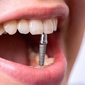 Имплант вертикально зажатый между верхними и нижними зубами