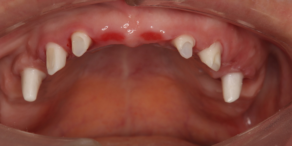 Удаление и обточка зубов, подготовка к имплантации