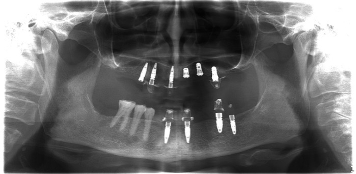 Рентгенопатомограмма верхней и нижней челюсти после имплантации с помощью Straumann Roxolid