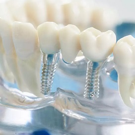 Прозрачный макет челюсти с имплантами, которые нагружены мостовидным протезом