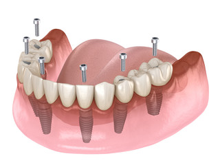 Зубной протез на 6 имплантах
