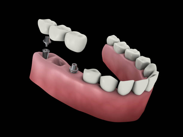 Мост на 3 зуба на имплантах