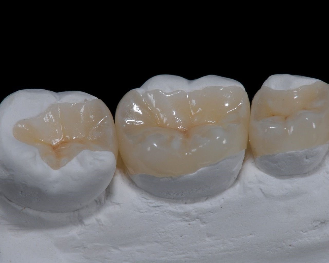 Микропротезы зубов — вкладки