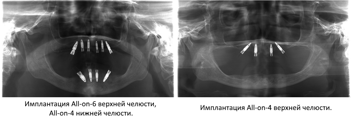 Слева - фото после имплантации по протоколам All-on-6/4 - для верхней и нижней челюстей соответственно, справа имплантация по протоколу All-on-4 на верхней челюсти