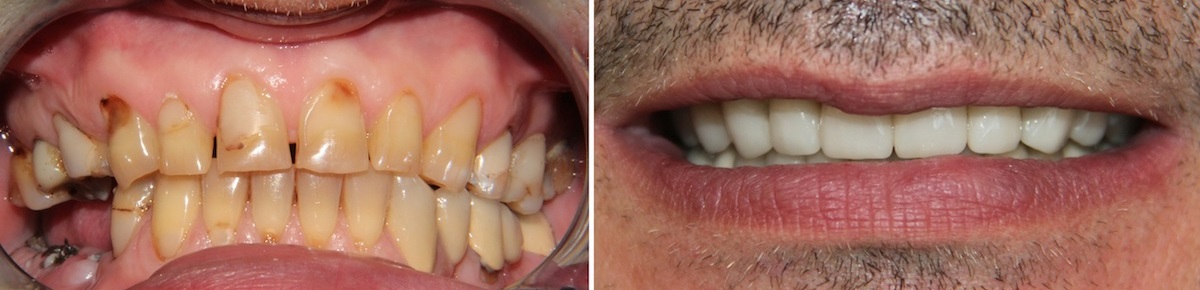 Фото до и после комплексого протезирования зубов с помощью протезированию на имплантах и виниров
