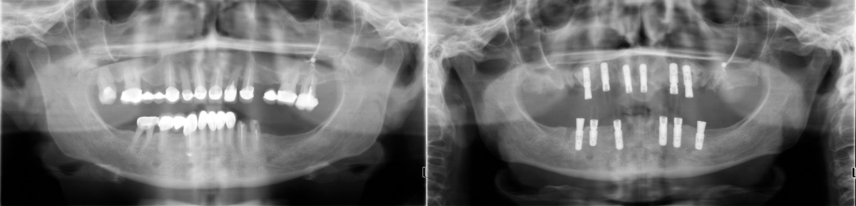 Панорамные рентгеновские снимки зубов до и после имплантации по Франкфуртскому протоколу