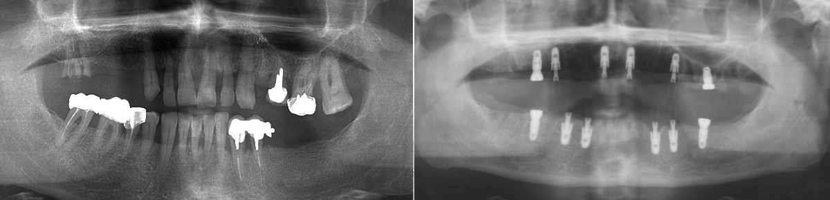 Ортопантомограмма до и после полной имплантации обеих челюстей
