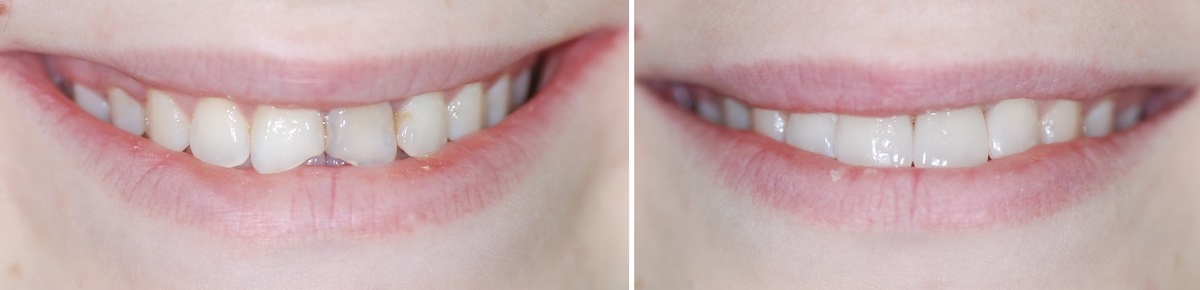 Фотография до и после протезирования передних зубов с помощью керамических виниров