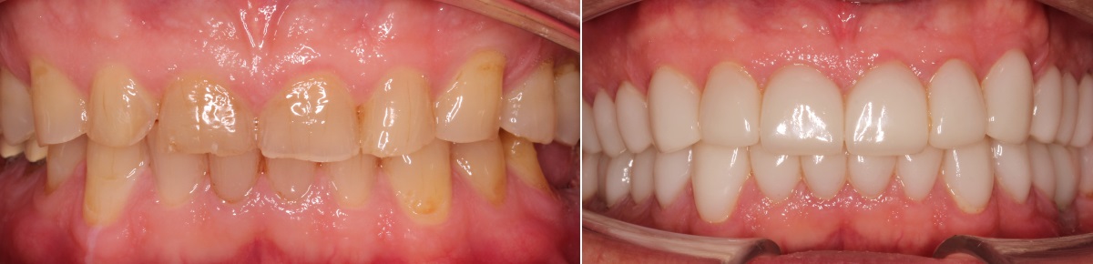 Фотография до и после протезирования передних зубов с помощью керамических виниров