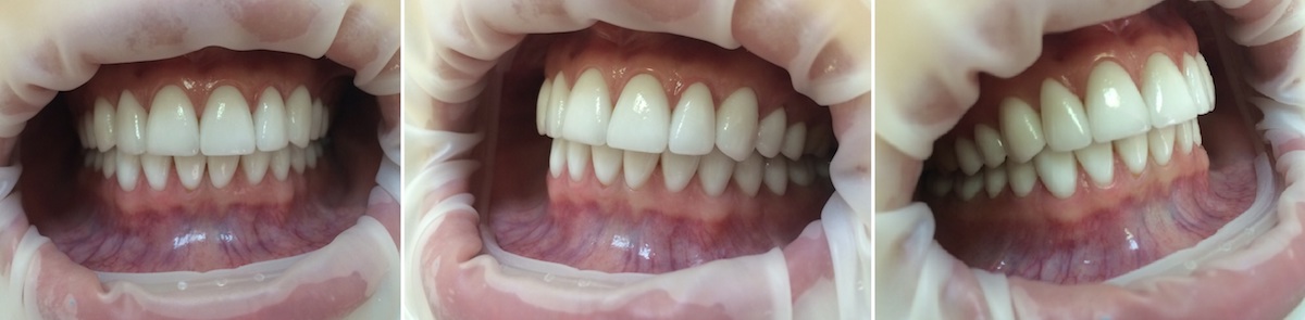 Фотографии зубов после установки люминиров
