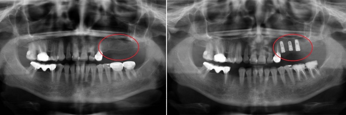 Рентгенопантомограмма всей челюсти до и после имплантации 3 титановых штифтов