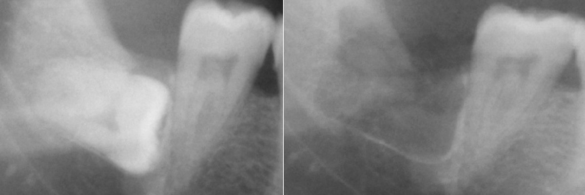 Рентег-снимок до и после удаления зуба мудпрости, который рос неправильно