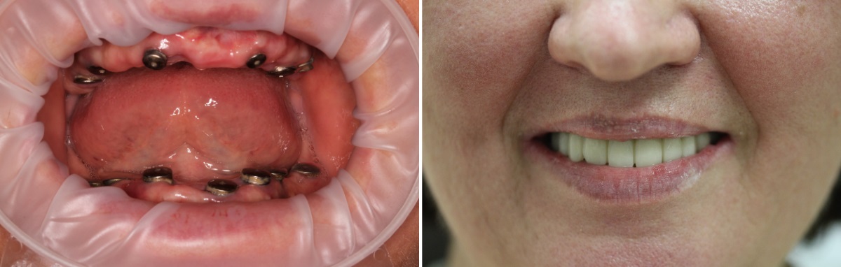 Две фотографии процесса полного протезирования зубов: слева - установленные импланты, справа - уже установленные протез