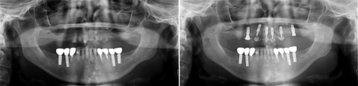 Панорамный рентген снимок до и после классической имплантации на 6 титановых стержнях и одномоментной нагрузкой несъёмным протезом