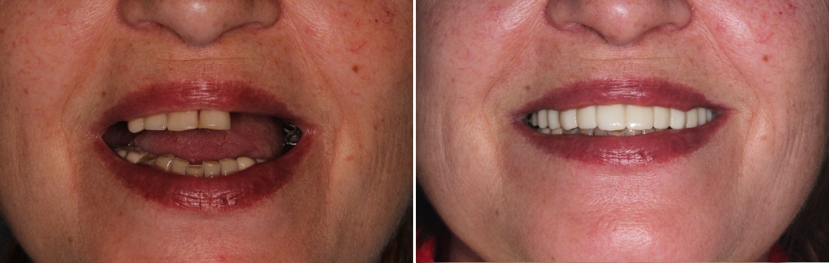 Фотография женщины до и после протезирования на 6 имплантах