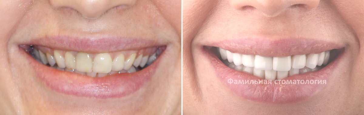 Фотография до и после: установка коронок на верхнюю челюсть и виниров на нижнюю
