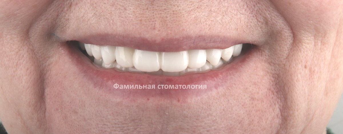 Фотография улыбки после полной имплантации верхней и нижней челюсти