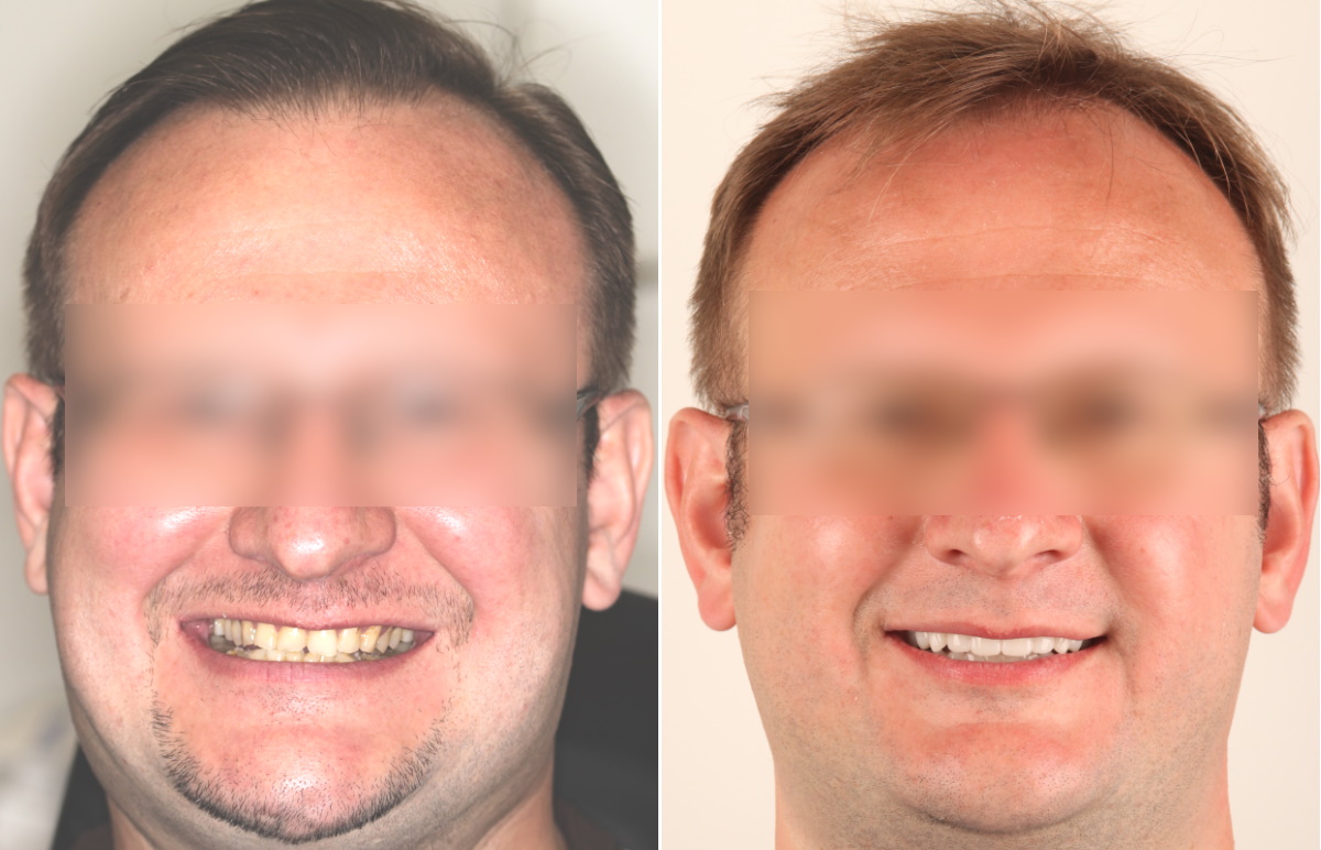 Фотография мужчины до и после комплексной реабилитации: установка коронок и исправление прикуса