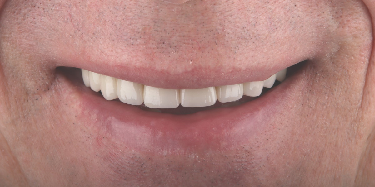 Фотграфия улыбки пацинта после полной реставрации верхней челюсти на имплантатах