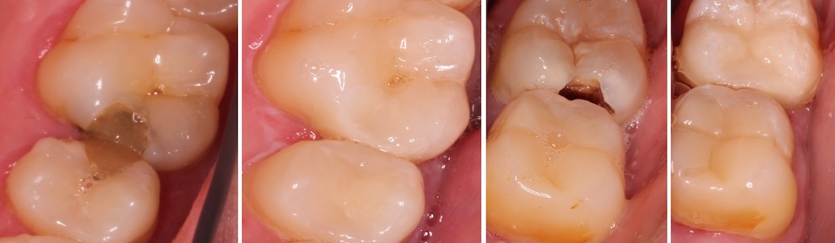 Фотография лечения двух случаев с кариесом при разрушении 1/3 (или более) поверхности зуба