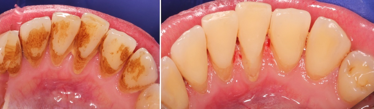 Фото до и после профессиональной гигиены полости рта, которая включает ультразвуковую чистку, Air Flow и полировку