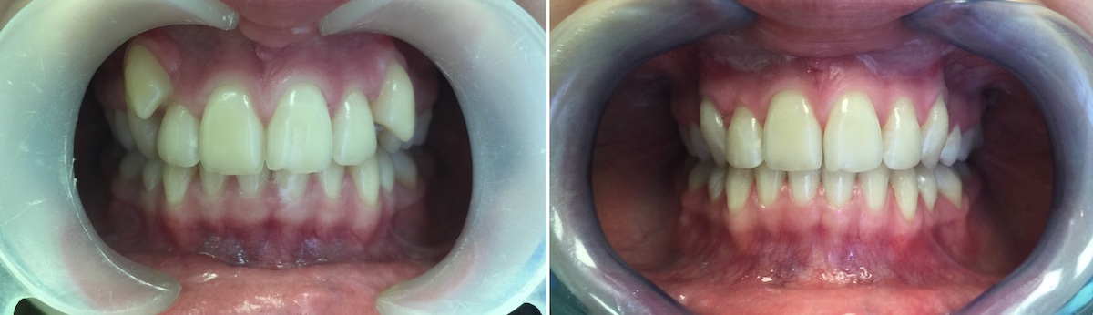 Фотография показывающая зубы до и после исправления прикуса с помощью брекет-системы