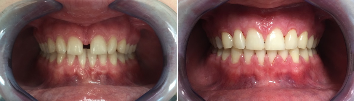 2 снимка: слева - до лечения диастемы и скученности на нижней челюсти с помощью брекетов, справа - после лечения на протяжении 15 месяцев