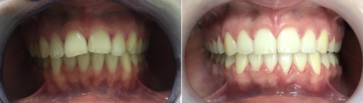 Две фотографии: слева - скученные зубы, справа - результат лечения с помощью брекетов на протяжении 14 месяцев
