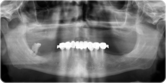 Панорамный снимок зубочелюстной системы до удаления всех зубов