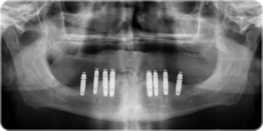 Панорамный снимок зубочелюстной системы после имплантации