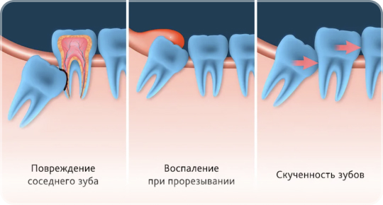 Что нельзя делать после удаления зуба взрослому